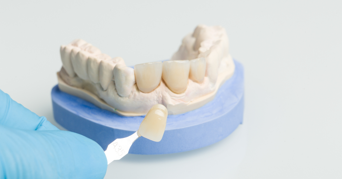 How Same-Day Crowns Can Enhance Your Smile in Just One Visit