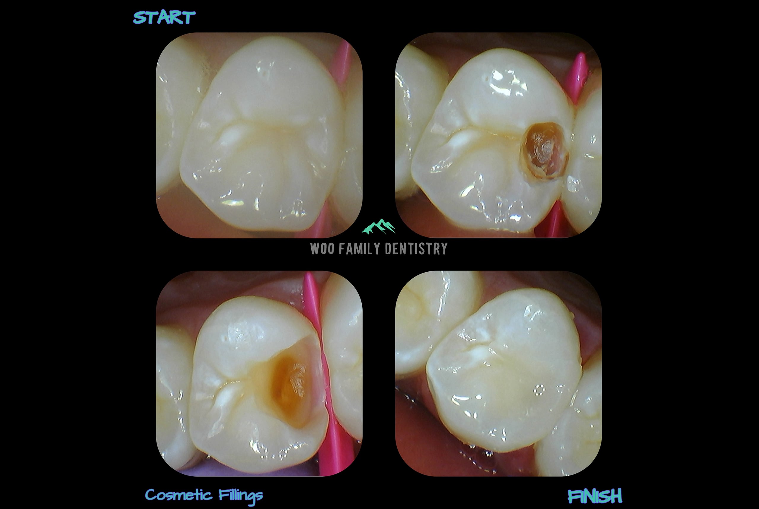 Cosmetic Fillings Start Finish