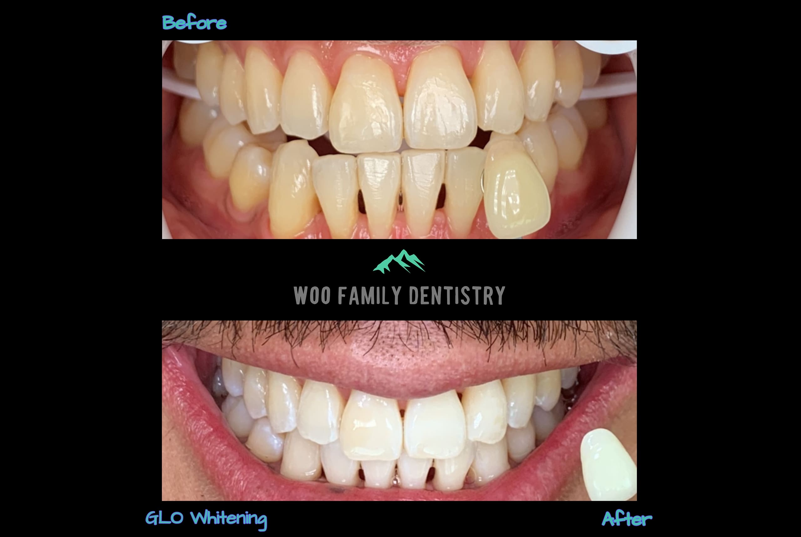 GLO Whitening Before After