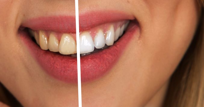 Professional Teeth Whitening