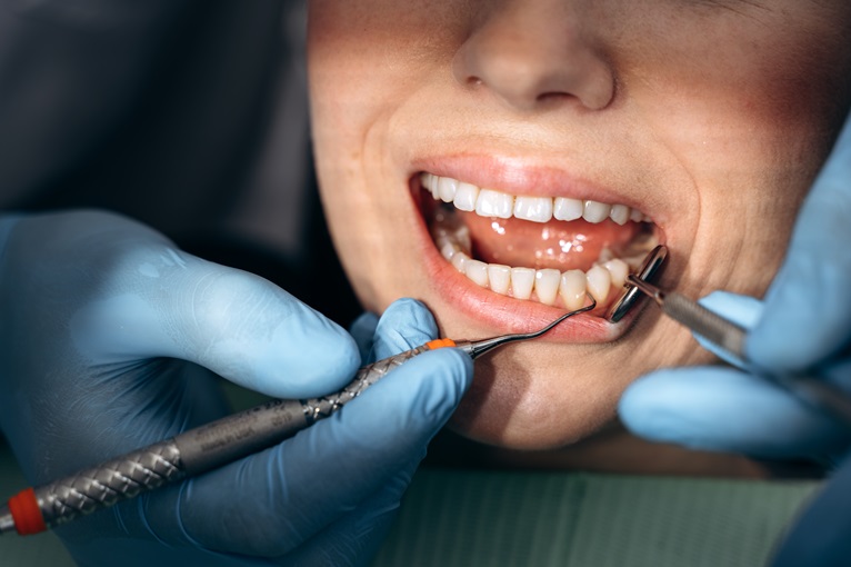 Top Signs You Might Need a Tooth Pulled: Insights from a Dentist